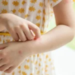 Warum jucken Mückenstiche? Ursachen verstehen und richtig behandeln