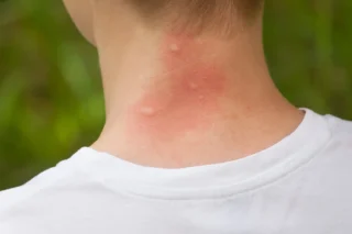 Mückenstich-Allergie: Symptome erkennen und richtig reagieren