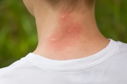 Mückenstich-Allergie: Symptome erkennen und richtig reagieren