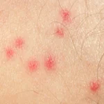 Mückenstiche – Symptome, Behandlung und sinnvolle Produkte im Überblick