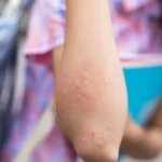 Mückenstiche-Bilder – so erkennen Sie typische Hautreaktionen