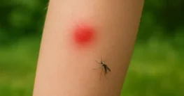 insektenstiche erkennen