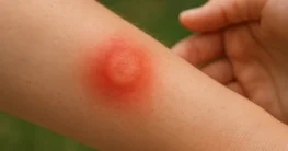 mückenstich allergie