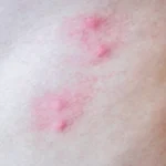 Wundrose nach Insektenstich: Symptome erkennen und richtig behandeln